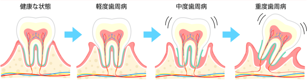 歯周病の進行度